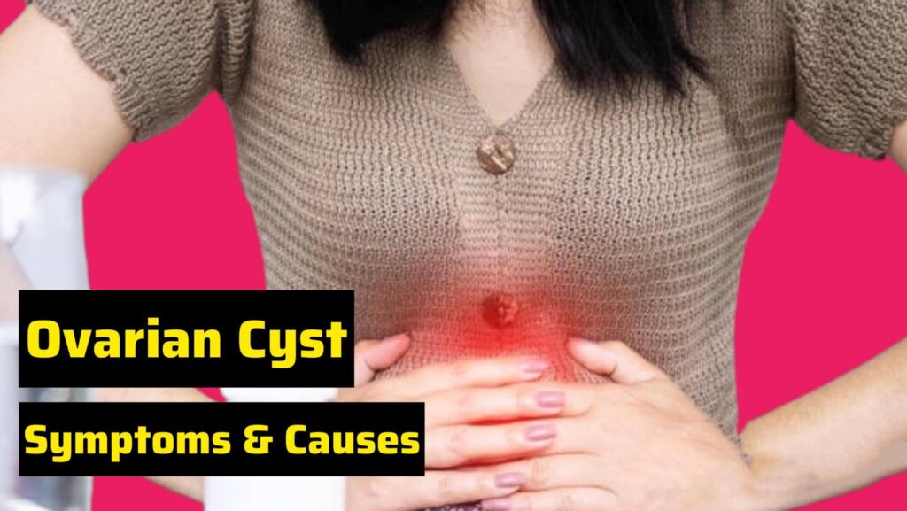 Ovarian Cyst